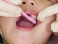 奥歯のかむ面の磨き方